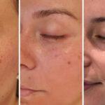I tried the cosmelan peel: here is what to expect during your depigmentation journey