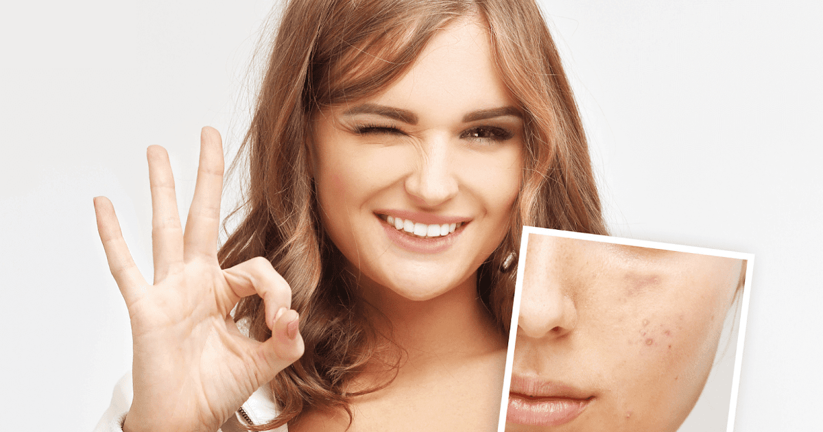 5 Effective Ways To Conceal Blemishes
