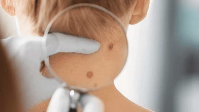 When to schedule An Appointment Dermatologists for Abnormal Moles, Barbies Beauty Bits