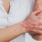 Psoriasis diagnoses in primary care may be delayed by up to five years