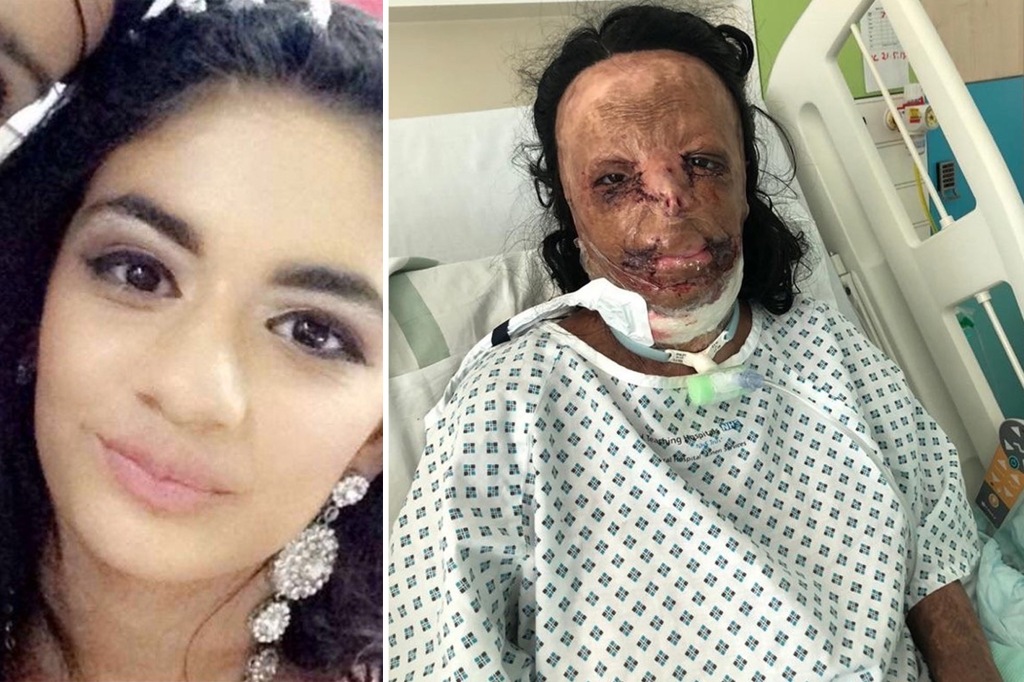 Aleema Ali, 18, was left with burns to more than half her body after a horrific accident in 2016. The youngster is seen at left prior to the incident, and at right during her nine month stint in hospital. 
