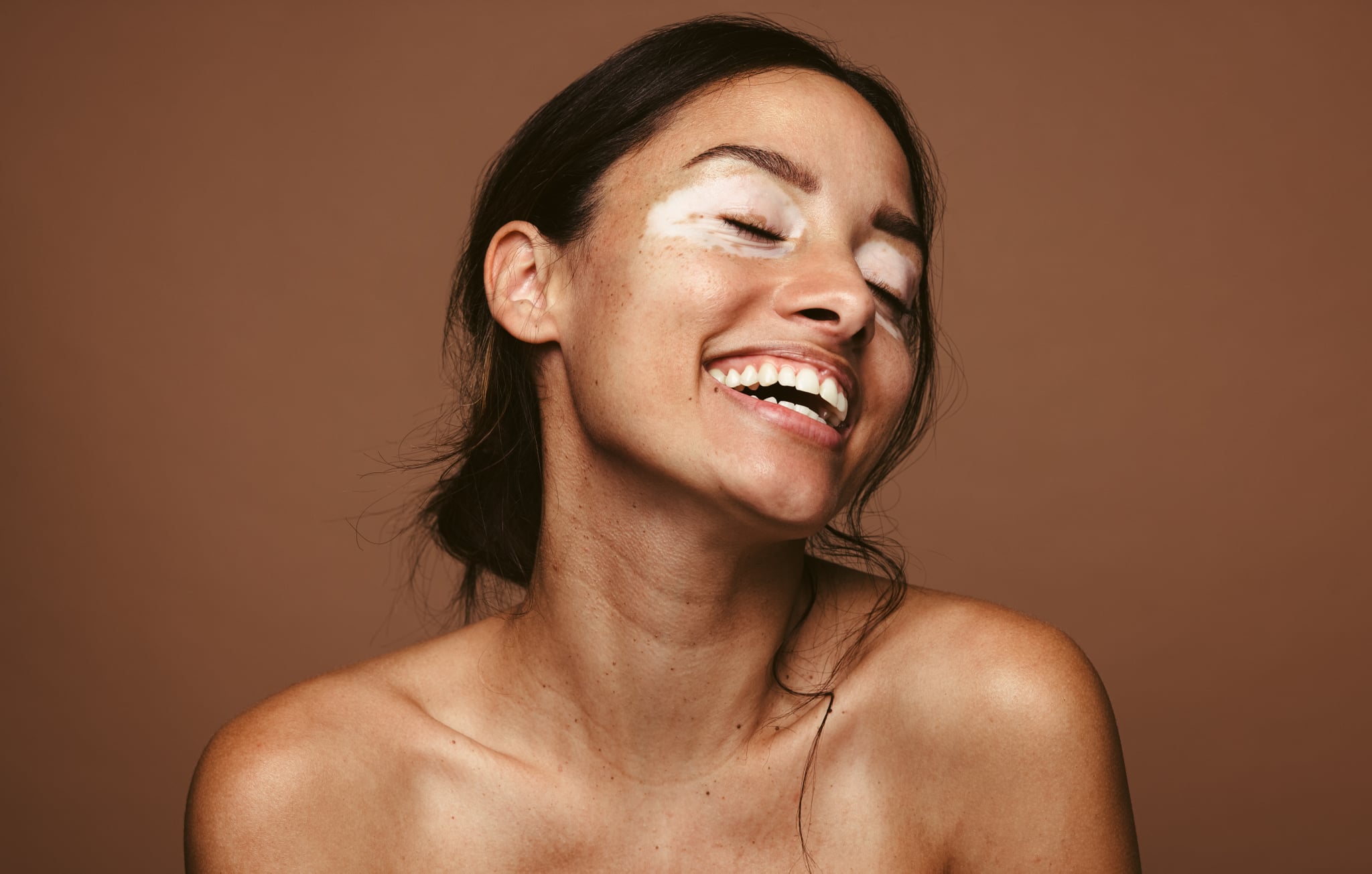 Portrait of a smiling young woman with vitiligo. Close up of woman with skin disorder smiling with eyes closed against brown background.